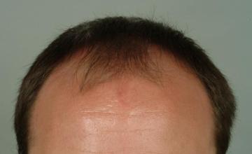 6 month results, one session, 2703 grafts/5287 hairs FUT-Robert Haber, MD