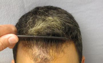 Hair Transplant results from Dr. Rose