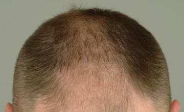 2 week follow-up ARTAS FUE procedure. 1944 grafts/3849 hairs- Robert Haber, MD