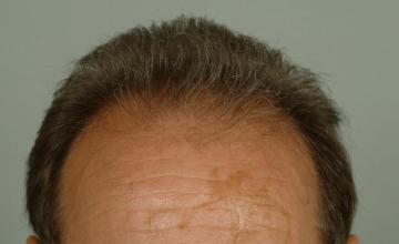 2 year followup, 3004 grafts/5472 hairs FUT- Robert Haber, MD