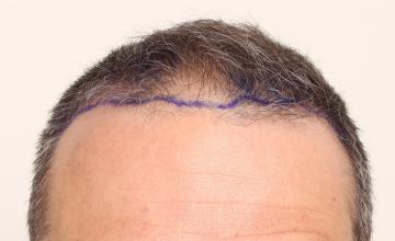 DR. DORIN - Thinning Class 4&gt;5A -  FUE 6 months