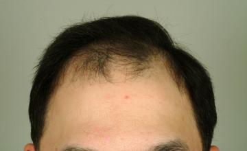 1 year followup, one session, 2261 grafts/3768 hairs FUT- Robert Haber, MD