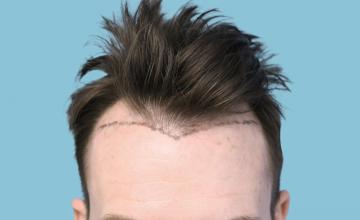 37 Year Old Male with Class III Hair Loss by Dr. Parsa Mohebi