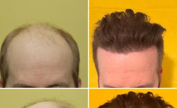 Dr Zarev 11,941 grafts. 1st procedure 8,321, 2nd procedure 3,620