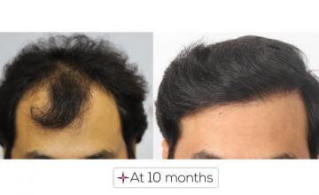 10 Months Hair Transplant Update | Grafts 2560, Norwood Grade 4A @Eugenix Hair Sciences