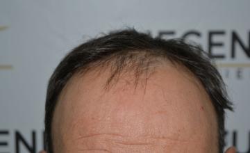 Dr. Munib Ahmad - 2415g - Salt and Pepper hairline - FueGenix - The Netherlands