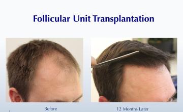 Male FUT Template (2019 grafts): Carlos K. Wesley, M.D. (NYC & LA)