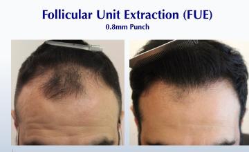 I'd Like a Healthy, Full Hairline (2760 grafts): Carlos K. Wesley, M.D. (NYC)