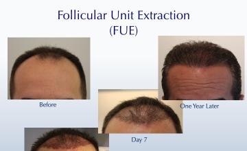 Revealing the Early Stages in an FUE Transformation  (2505 FUE grafts): Carlos K. Wesley, M.D. (NYC & LA)