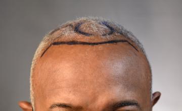 Dr. Arocha | 1500 Graft FUE + SMP (crown) | 14 month results