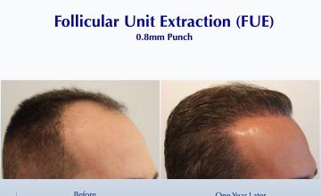 "The Postoperative Timeline of FUE" (2505 grafts): Carlos K. Wesley, M.D. (NYC & LA)