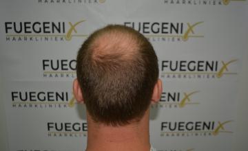 Dr. Munib Ahmad - 2470g - Crown - 1 Year Result - FueGenix - The Netherlands [Next Level Comb Through]