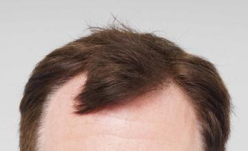 Dr B Farjo 1600g FUE Hairline