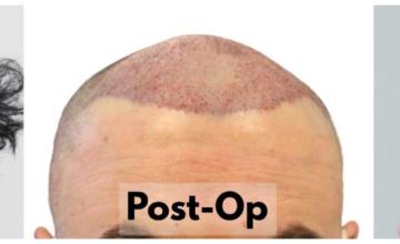 2823 Grafts via FUE with Dr. Rahal - 1 Year Results