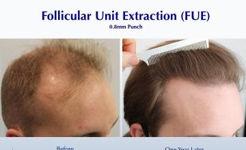 Return of Original Hair Coloration & Fullness (2829 FUE grafts): Carlos K. Wesley, M.D. (NYC & LA)