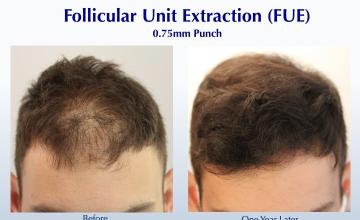 Filling in the Front (2832 FUE grafts): Carlos K. Wesley, M.D. (NYC & LA)