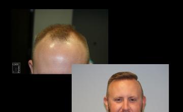 PANINE, MD - Chicago Hair Transplant Clinic | FUE Hair Restoration Surgery w/ 2,861 Grafts