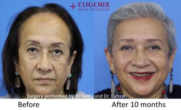 Amazing female hair transplantation at the age of 70!