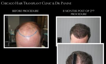 PANINE, MD - Chicago Hair Transplant Clinic Patient Results After 2 Procedures