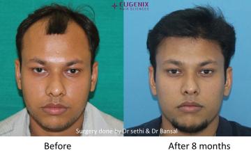 Results @ Dr Pradeep Sethi and Dr Arika Bansal, 2890 FUE/DHT grafts; 8 months post-op