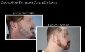 PANINE, MD & CHICAGO HAIR TRANSPLANT CLINIC - FUE Beard Transplant