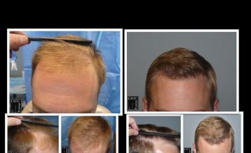 PANINE, MD | CHICAGO HAIR TRANSPLANT CLINIC | FUE Hair Restoration Results with 2,166 Grafts