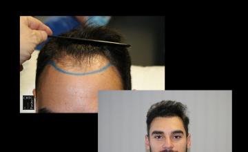 PANINE, MD | Chicago Hair Transplant Clinic - FUE Hair Restoration Patient Results with 2,540 Grafts