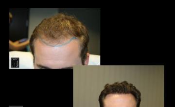 PANINE, MD | Chicago Hair Transplant Clinic - FUT Hair Restoration w/ 2,720 Grafts