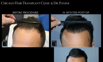 PANINE, MD - Chicago Hair Transplant Clinic Patient Results w/ 2,932 grafts