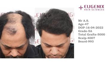 EUGENIX HAIR SCEINCES | GRADE 5A | 11.5 MONTHS RESULT
