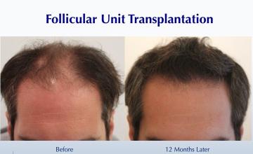 No More Thinning Corridor (2691 grafts): Carlos K. Wesley, M.D. (NYC)