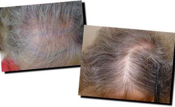 Hair restoration procedure results