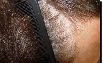 Hair restoration procedure results