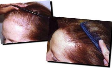 Hair restoration procedure results