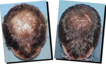 Hair restoration procedure results