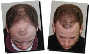 Hair restoration procedure results