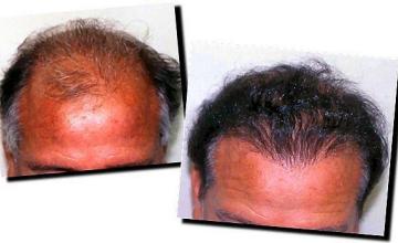 Hair restoration procedure results