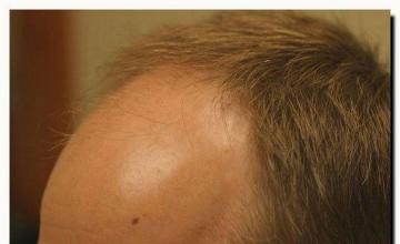 Hair restoration procedure results