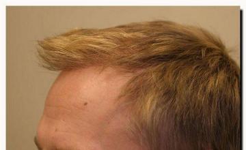 Hair restoration procedure results