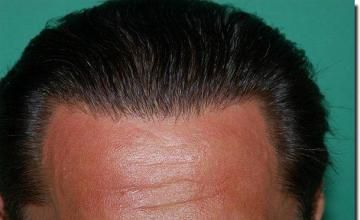 Hair restoration procedure results