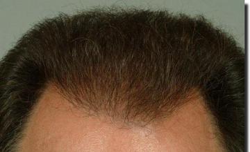 Hair restoration procedure results