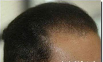 Hair restoration procedure results