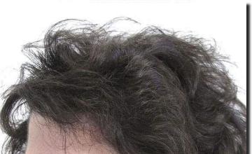 Hair restoration procedure results