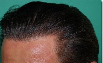 Hair restoration procedure results