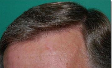 Hair restoration procedure results