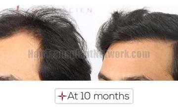 Left view before and after hair transplant surgery