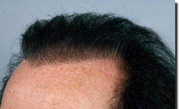 Hair restoration procedure results