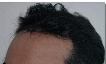 Hair restoration procedure results