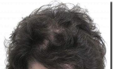 Hair restoration procedure results