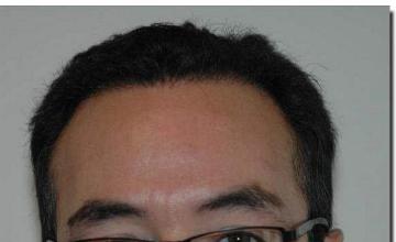 Hair restoration procedure results